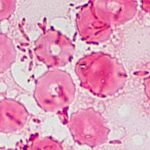 Una mujer en EE.UU contrae una rara enfermedad por su acuario