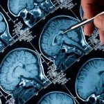 Identifican un biomarcador que detecta las fases iniciales del Alzheimer