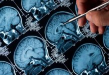 Identifican un biomarcador que detecta las fases iniciales del Alzheimer Identifican un biomarcador que detecta las fases iniciales del Alzheimer