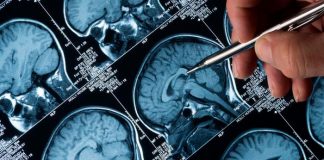 Identifican un biomarcador que detecta las fases iniciales del Alzheimer