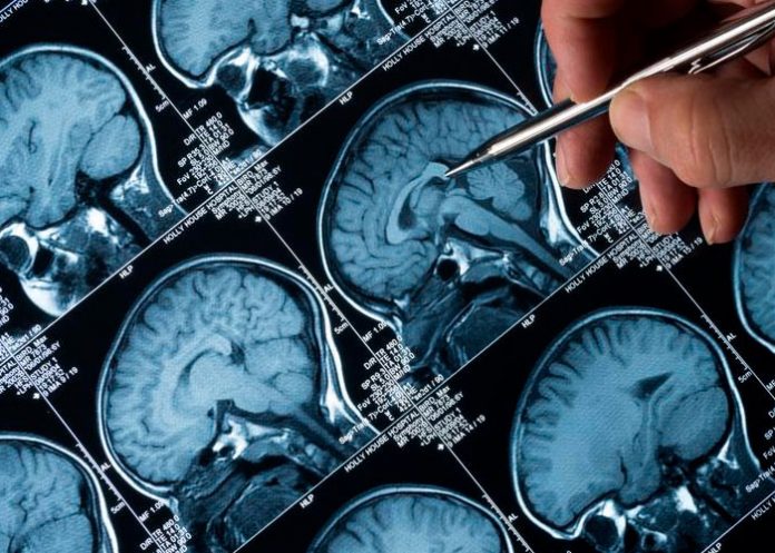 Identifican un biomarcador que detecta las fases iniciales del Alzheimer