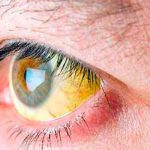 Brote de hepatitis A deja en EE.UU. 50 enfermos y una persona muerta