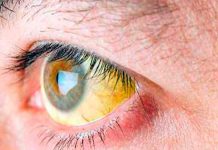 Brote de hepatitis A deja en EE.UU. 50 enfermos y una persona muerta Brote de hepatitis A deja en EE.UU. 50 enfermos y una persona muerta