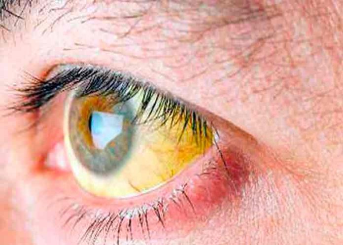 Brote de hepatitis A deja en EE.UU. 50 enfermos y una persona muerta