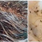 ¡De impacto! Niña aterroriza las redes al mostrar su cabeza llena de piojos ¡De impacto! Niña aterroriza las redes al mostrar su cabeza llena de piojos