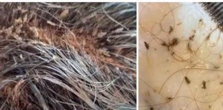 ¡De impacto! Niña aterroriza las redes al mostrar su cabeza llena de piojos