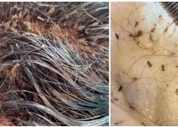 ¡De impacto! Niña aterroriza las redes al mostrar su cabeza llena de piojos