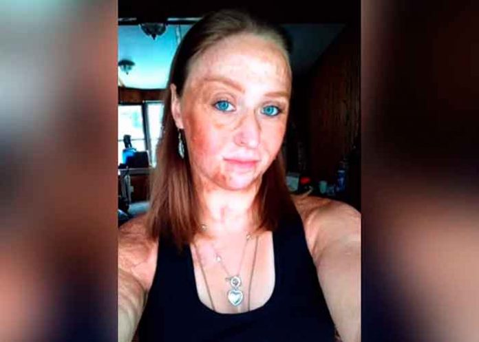 ¡No lo hagan! Usó gasolina para quitarle los piojos y casi muere por quemaduras en su cuerpo