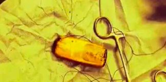 Se quejaba de dolor estomacal y descubrieron un teléfono en su intestino
