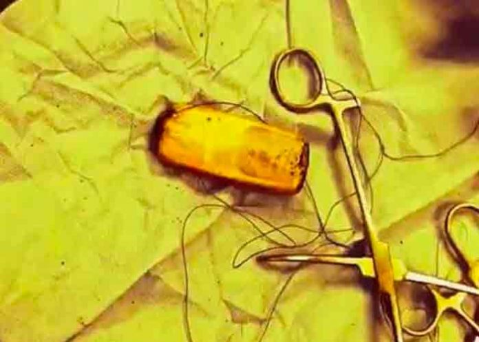 telefono-portada- Se quejaba de dolor estomacal y descubrieron un teléfono en su intestino