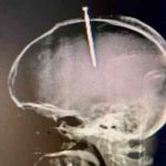 Se incrustó un clavo en la cabeza porque sentía «flojo el cerebro» Increíble: Se incrustó un clavo en la cabeza porque sentía "flojo el cerebro"