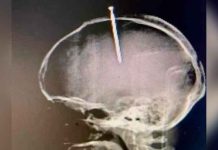 Se incrustó un clavo en la cabeza porque sentía «flojo el cerebro» Increíble: Se incrustó un clavo en la cabeza porque sentía "flojo el cerebro"