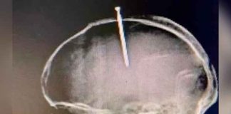 Increíble: Se incrustó un clavo en la cabeza porque sentía "flojo el cerebro"