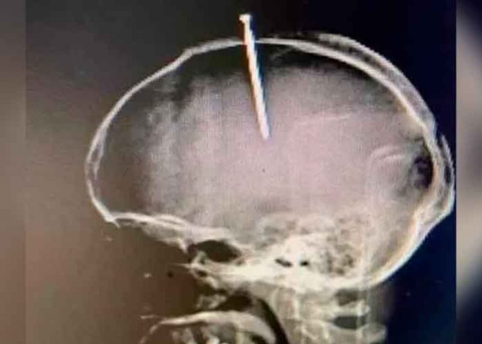 medico3 Increíble: Se incrustó un clavo en la cabeza porque sentía