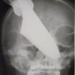¡Ataque brutal! Le clavaron un cuchillo en el rostro a una Mujer en Rusia ¡Ataque brutal! Le clavaron un cuchillo en el rostro a una Mujer en Rusia