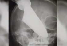 ¡Ataque brutal! Le clavaron un cuchillo en el rostro a una Mujer en Rusia