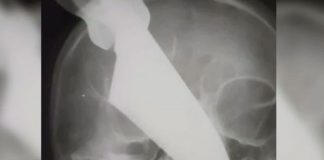 ¡Ataque brutal! Le clavaron un cuchillo en el rostro a una Mujer en Rusia