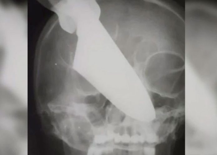 ¡Ataque brutal! Le clavaron un cuchillo en el rostro a una Mujer en Rusia