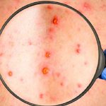 OMS alerta a mantener vigilancia y vacunar contra el sarampión