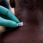 Detectan un caso positivo de viruela del mono en un paciente de EE.UU