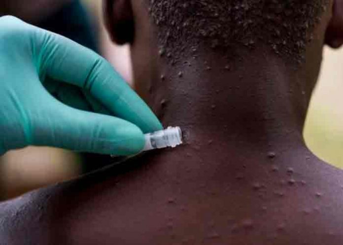 Detectan un caso positivo de viruela del mono en un paciente de EE.UU