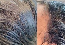 Tenes piojos y te da pena rascarte en público, aquí te dejamos cómo combatirlos.