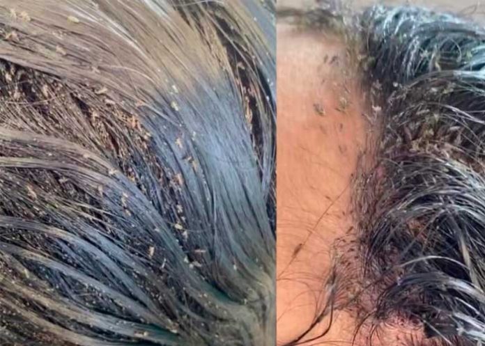 Tenes piojos y te da pena rascarte en público, aquí te dejamos cómo combatirlos.