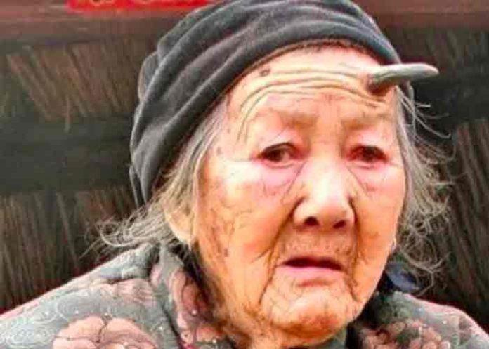 Zhang Ruifang se vuelve viral por su cuerno de seis centímetros en la frente