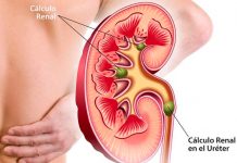 Pacientes con cálculo renal aumentarán debido al cambio climático Pacientes con cálculo renal aumentarán debido al cambio climático