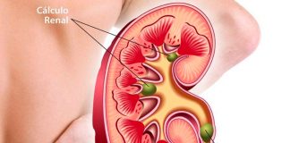 Pacientes con cálculo renal aumentarán debido al cambio climático