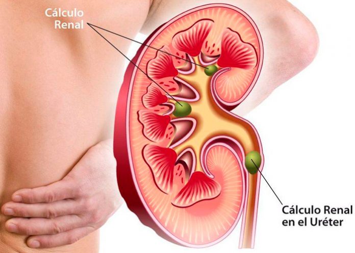 Pacientes con cálculo renal aumentarán debido al cambio climático