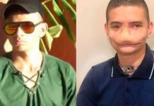 La historia del joven de Brasil que tiene la cara desfigurada por la pirotecnia : La historia del joven de Brasil que tiene la cara desfigurada por la pirotecnia