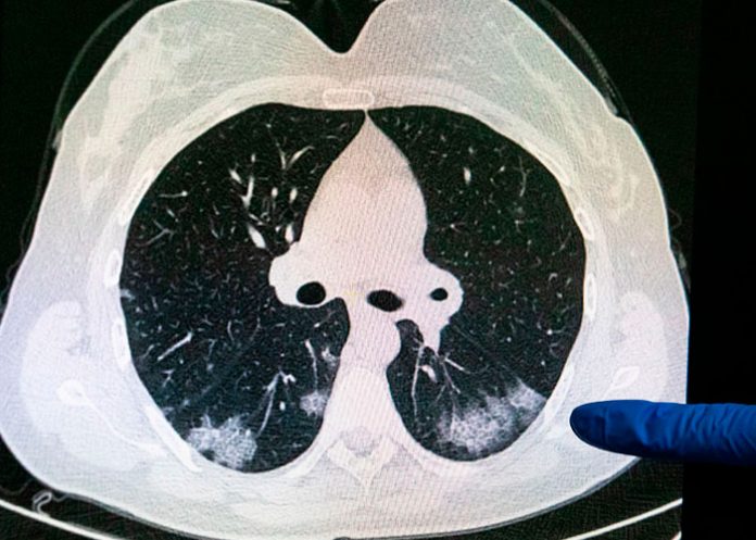9 personas mueren a causa de misteriosa enfermedad neuronal en Canadá