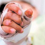 Escondían a su hijo quemado por pólvora para evitar ser multados en Colombia