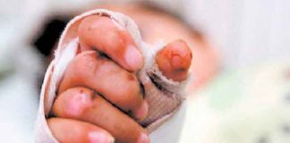 Escondían a su hijo quemado por pólvora para evitar ser multados en Colombia