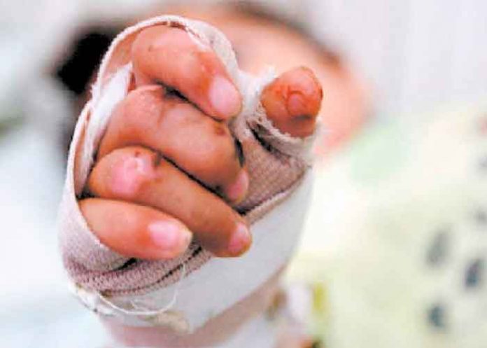 colombia- Escondían a su hijo quemado por pólvora para evitar ser multados en Colombia