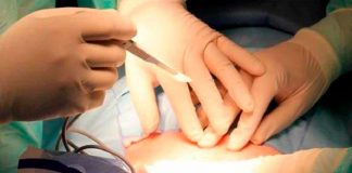 Mujer vivió con tijera quirúrgica dentro del abdomen ¡durante 20 años! en Bangladesh