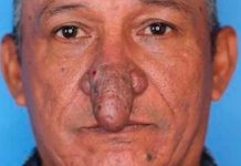 No más bullying para sujeto que se operó su nariz en forma de falo (IMÁGENES)