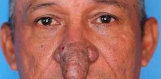 No más bullying para sujeto que se operó su nariz en forma de falo (IMÁGENES)