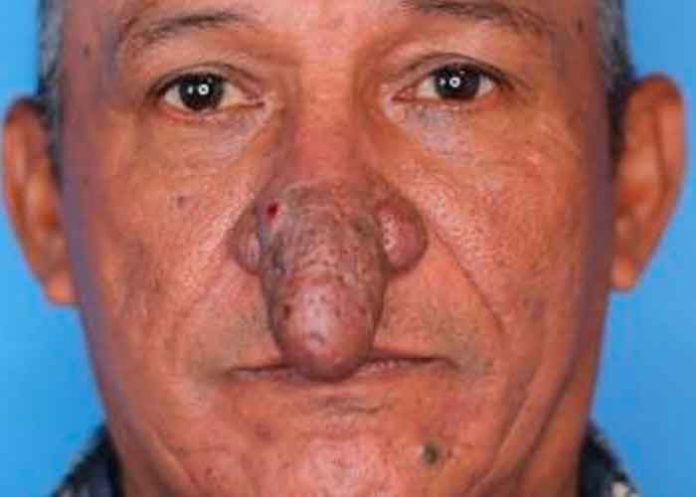 No más bullying para sujeto que se operó su nariz en forma de falo (IMÁGENES)