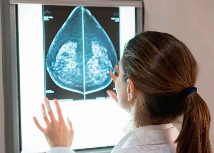 Científicos crean un fármaco que frena la metástasis en cáncer de mama