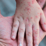 Brote de sarampión deja más de 150 muertos en Afganistán