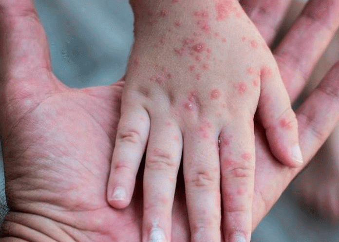 Brote de sarampión deja más de 150 muertos en Afganistán