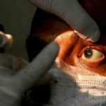 Aumentan a 31 los casos de hongo negro en Honduras Aumentan a 31 los casos de hongo negro en Honduras