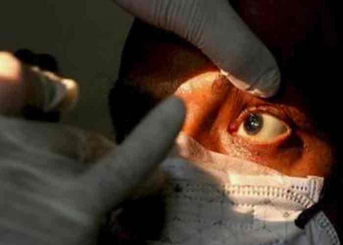 Aumentan a 31 los casos de hongo negro en Honduras