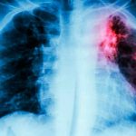 La OMS pide una inversión masiva para frenar la tuberculosis