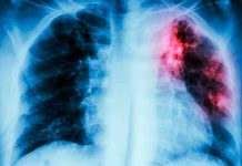 La OMS pide una inversión masiva para frenar la tuberculosis La OMS pide una inversión masiva para frenar la tuberculosis