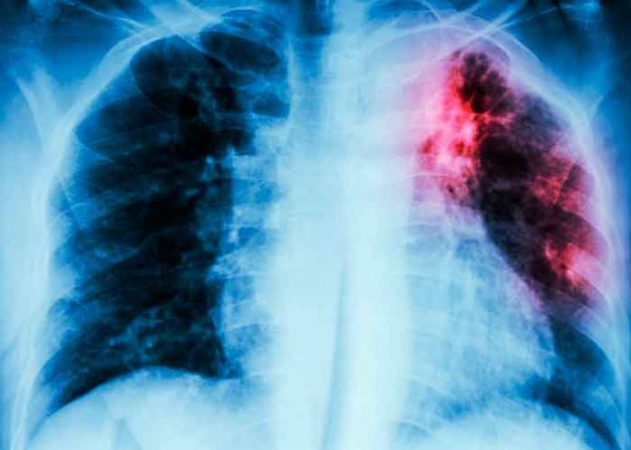 La OMS pide una inversión masiva para frenar la tuberculosis