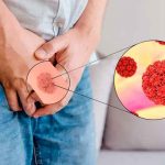 El virus del papiloma humano puede causar cáncer en los hombres.