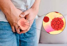 El virus del papiloma humano puede causar cáncer en los hombres El virus del papiloma humano puede causar cáncer en los hombres.